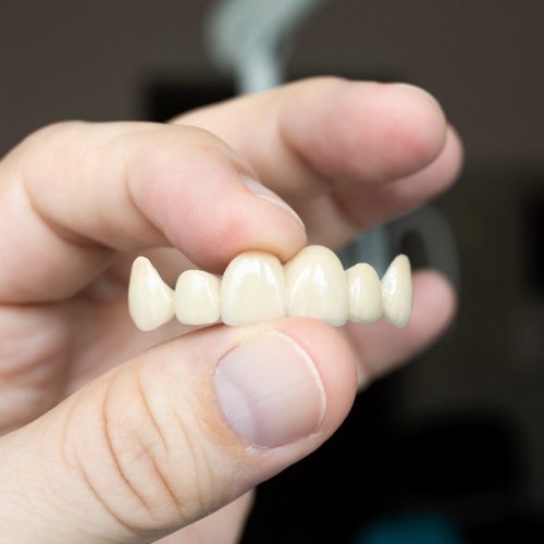 The,Dentist,Holds,A,Ceramic,,Zirconium,,Bridge-shaped,,Non-removable,Dental,Prosthesis