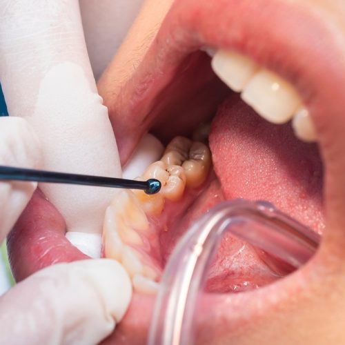 A,Dental,Professional,Places,Composite,Resin,Into,A,Prepared,Cavity