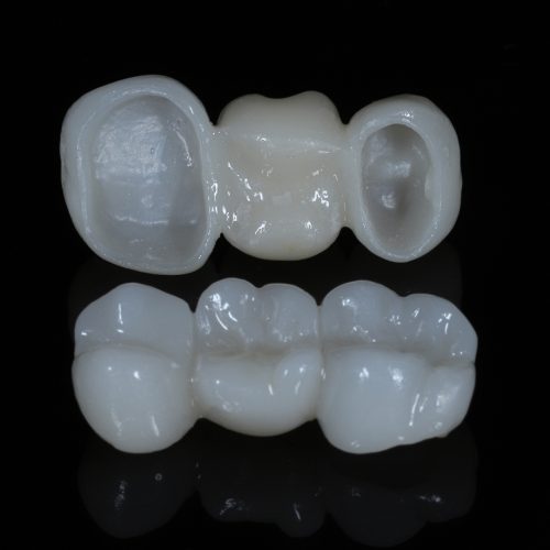 Bridge,Crown,Prosthesis,Treatment,In,Dental,Aesthetic,Dentistry,For,Missing