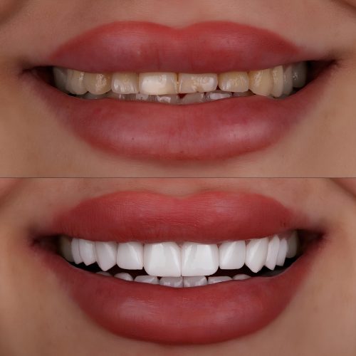 The,Smile,Design,Treatment,Of,A,Woman,With,Beautiful,Lips,